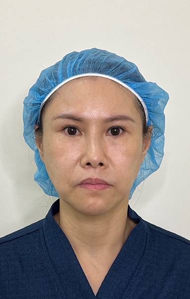 骨架外型和組織肉的厚度應該多少比例？3D列印技術墊蘋果肌給妳