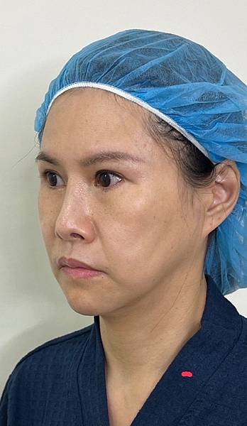 骨架外型和組織肉的厚度應該多少比例？3D列印技術墊蘋果肌給妳