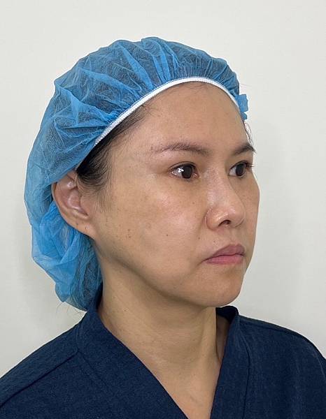 骨架外型和組織肉的厚度應該多少比例？3D列印技術墊蘋果肌給妳