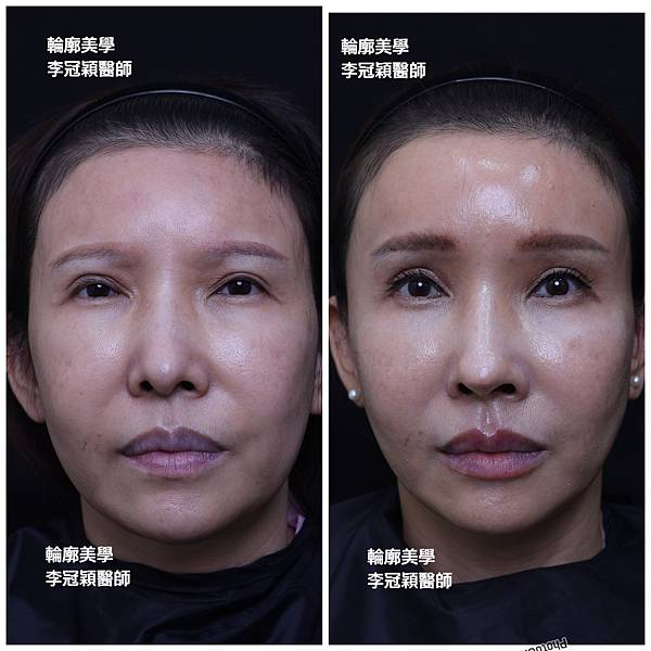 東方臉墊眉骨(隆眉骨)的輪廓效果,顏面T區打造的逆轉! 東方臉墊眉骨(隆眉骨)的輪廓效果,顏面T區打造的逆轉!