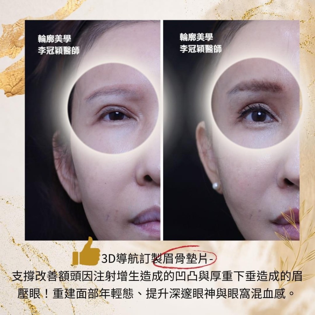 如何選擇適合的眼整形醫師？