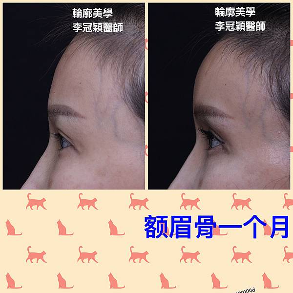 東方臉墊眉骨(隆眉骨)的輪廓效果,顏面T區打造的逆轉! 東方臉墊眉骨(隆眉骨)的輪廓效果,顏面T區打造的逆轉!