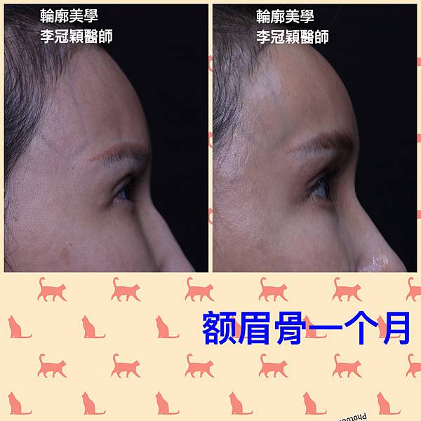 東方臉墊眉骨(隆眉骨)的輪廓效果,顏面T區打造的逆轉! 東方臉墊眉骨(隆眉骨)的輪廓效果,顏面T區打造的逆轉!