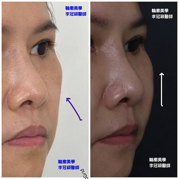 骨架外型和組織肉的厚度應該多少比例？3D列印技術墊蘋果肌給妳