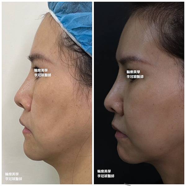 骨架外型和組織肉的厚度應該多少比例？3D列印技術墊蘋果肌給妳