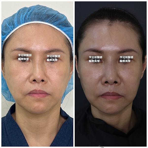 骨架外型和組織肉的厚度應該多少比例？3D列印技術墊蘋果肌給妳