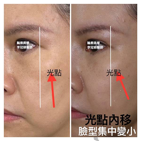 骨架外型和組織肉的厚度應該多少比例？3D列印技術墊蘋果肌給妳