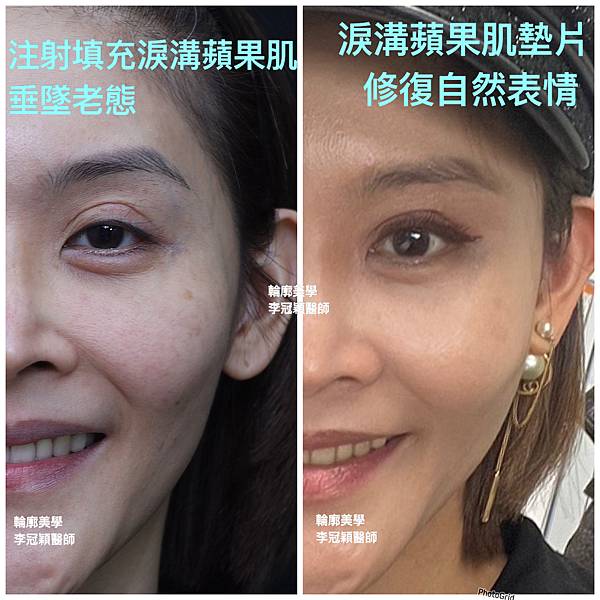 3D列印技術：提升蘋果肌的完美比例