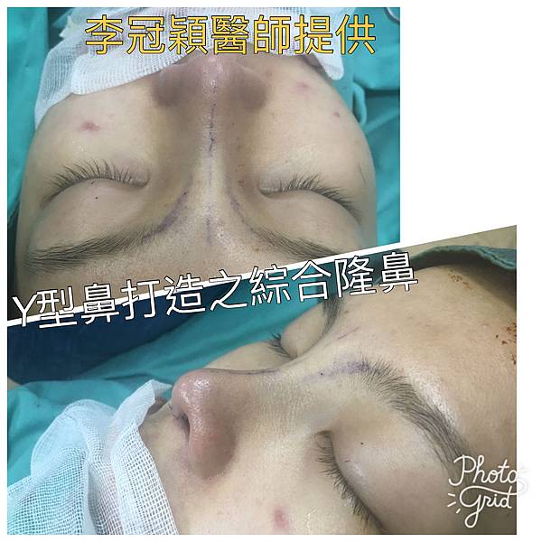 妳的國產臉條件能做Y型鼻（Y字眉心）嗎？和y鼻根有何不同？A