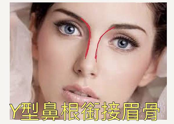 妳的國產臉條件能做Y型鼻（Y字眉心）嗎？和y鼻根有何不同？A
