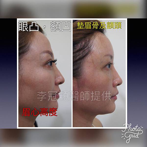 妳的國產臉條件能做Y型鼻（Y字眉心）嗎？和y鼻根有何不同？A