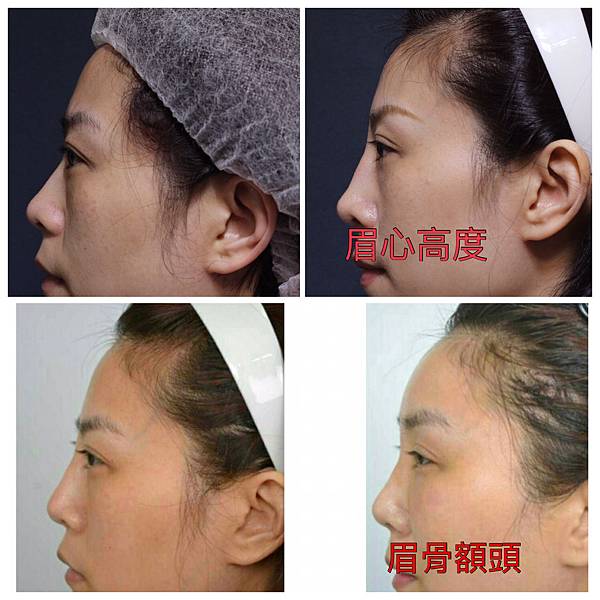 妳的國產臉條件能做Y型鼻（Y字眉心）嗎？和y鼻根有何不同？A