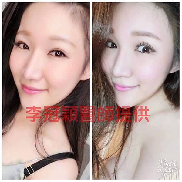 妳的國產臉條件能做Y型鼻（Y字眉心）嗎？和y鼻根有何不同？A