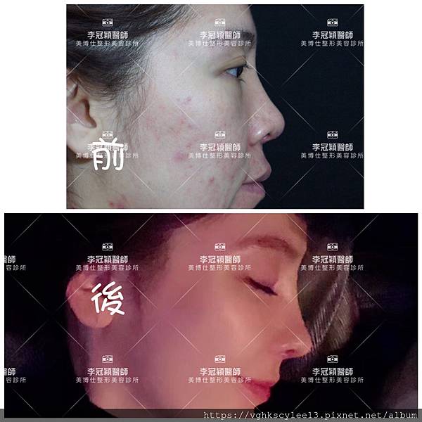 俏鼻不是韓式鼻翹！『鼻額弧線』會是另一個貼近東方特性的鼻線條