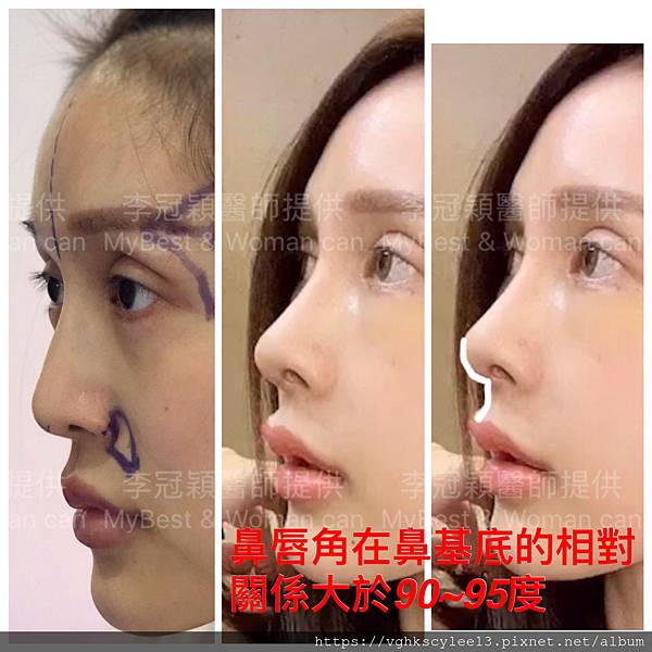 俏鼻不是韓式鼻翹！『鼻額弧線』會是另一個貼近東方特性的鼻線條