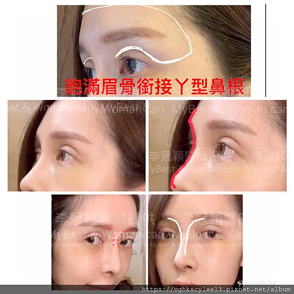 俏鼻不是韓式鼻翹！『鼻額弧線』會是另一個貼近東方特性的鼻線條