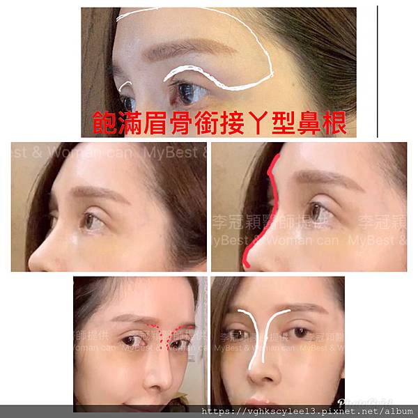 妳的國產臉條件能做Y型鼻（Y字眉心）嗎？和y鼻根有何不同？A