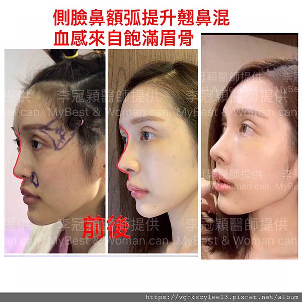 妳的國產臉條件能做Y型鼻（Y字眉心）嗎？和y鼻根有何不同？A