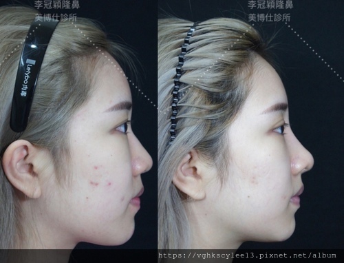 妳的國產臉條件能做Y型鼻（Y字眉心）嗎？和y鼻根有何不同？A