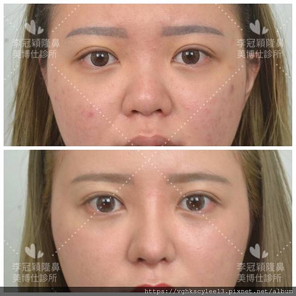 『鼻雕』還是『鼻凋』?到底鼻子埋線有什麼風險必須知道?你的埋 『鼻雕』還是『鼻凋』?到底鼻子埋線有什麼風險必須知道?你的埋