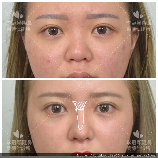 『鼻雕』還是『鼻凋』?到底鼻子埋線有什麼風險必須知道?你的埋 『鼻雕』還是『鼻凋』?到底鼻子埋線有什麼風險必須知道?你的埋