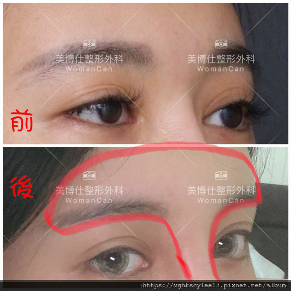 妳的國產臉條件能做Y型鼻（Y字眉心）嗎？和y鼻根有何不同？A