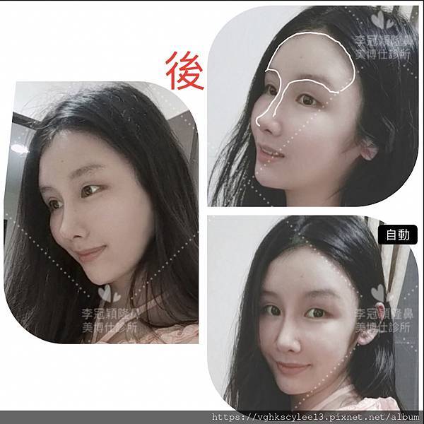 妳的國產臉條件能做Y型鼻（Y字眉心）嗎？和y鼻根有何不同？A