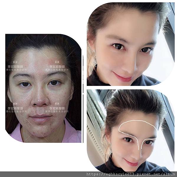 妳的國產臉條件能做Y型鼻（Y字眉心）嗎？和y鼻根有何不同？A