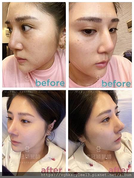 俏鼻不是韓式鼻翹！『鼻額弧線』會是另一個貼近東方特性的鼻線條