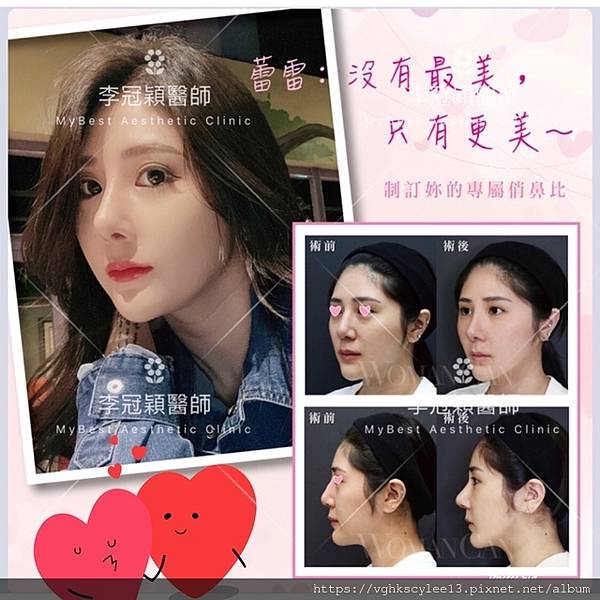 俏鼻不是韓式鼻翹！『鼻額弧線』會是另一個貼近東方特性的鼻線條