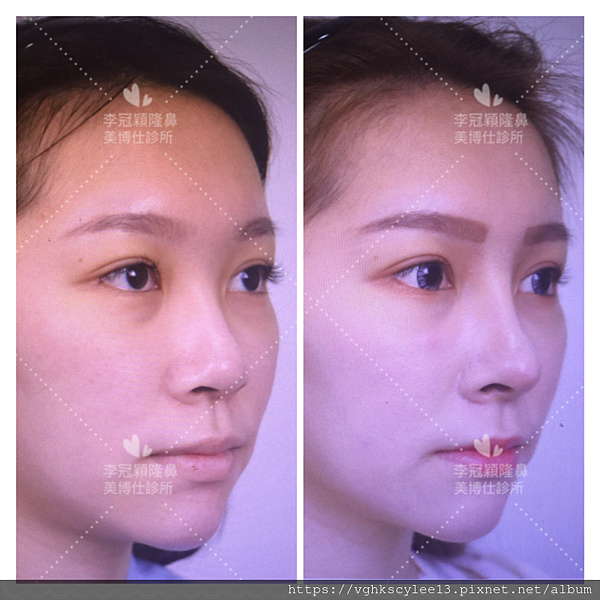 俏鼻不是韓式鼻翹！『鼻額弧線』會是另一個貼近東方特性的鼻線條