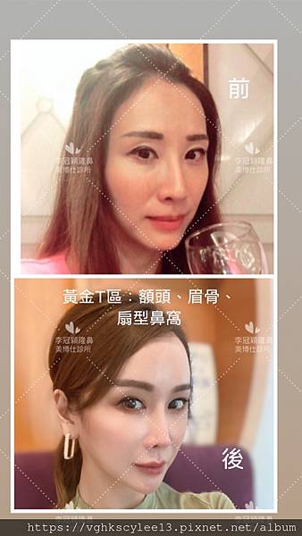 俏鼻不是韓式鼻翹！『鼻額弧線』會是另一個貼近東方特性的鼻線條