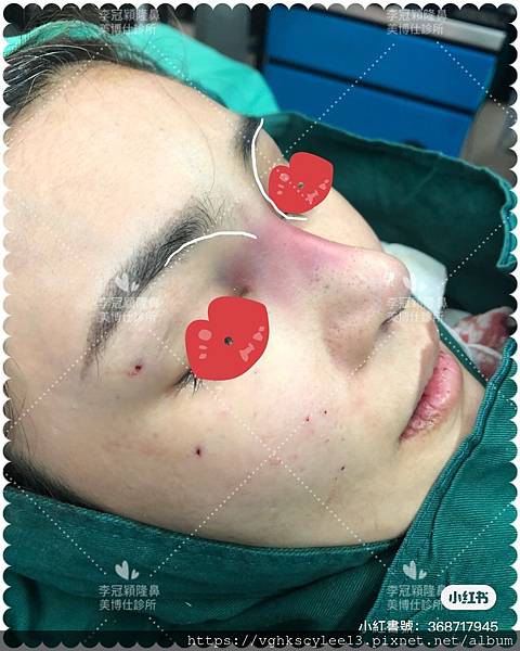 妳的國產臉條件能做Y型鼻（Y字眉心）嗎？和y鼻根有何不同？A