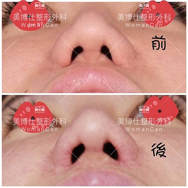 隆鼻價位多少?為什麼差異大!原因? 隆鼻價位多少?為什麼差異大!原因?