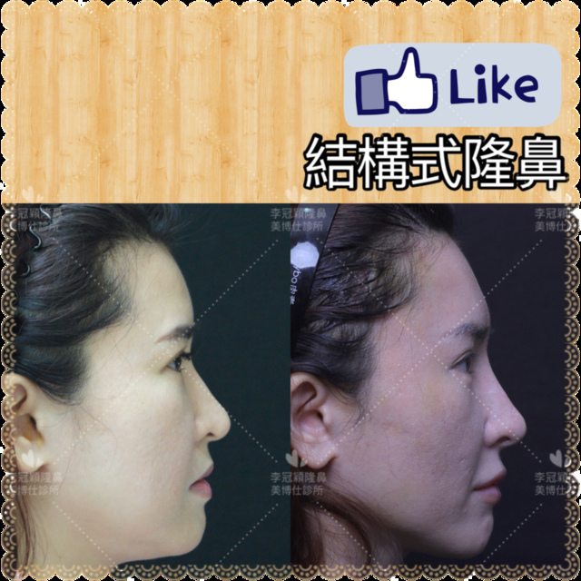 隆鼻價位多少?為什麼差異大!原因? IMG_7704 2.PNG - 鼻整形