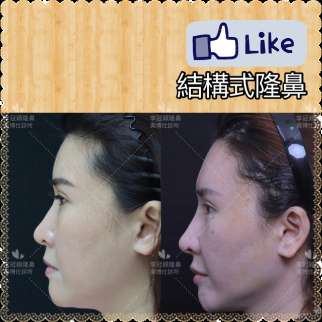 隆鼻價位多少?為什麼差異大!原因? IMG_7706 2.PNG - 鼻整形