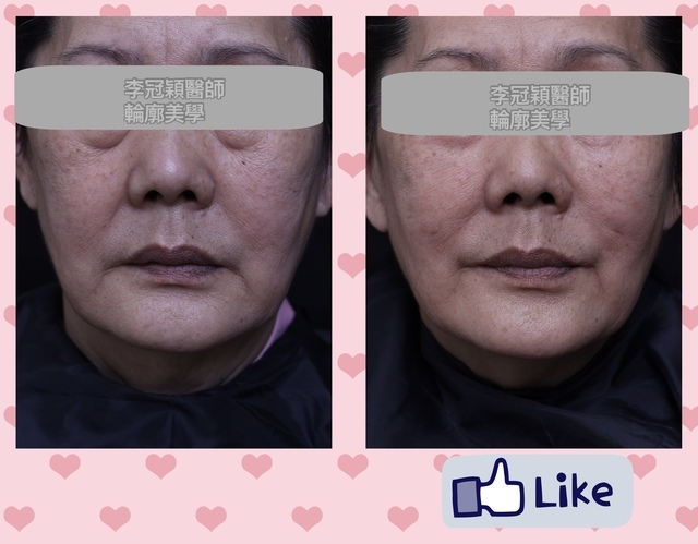 IMG_3550.jpg - 蘋果肌墊片貓咪紋問題