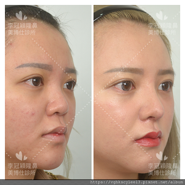 『鼻雕』還是『鼻凋』?到底鼻子埋線有什麼風險必須知道?你的埋 『鼻雕』還是『鼻凋』?到底鼻子埋線有什麼風險必須知道?你的埋