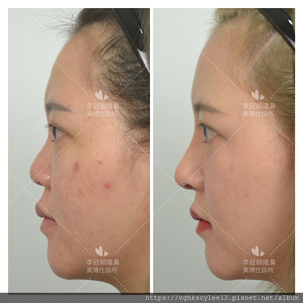 『鼻雕』還是『鼻凋』?到底鼻子埋線有什麼風險必須知道?你的埋 『鼻雕』還是『鼻凋』?到底鼻子埋線有什麼風險必須知道?你的埋