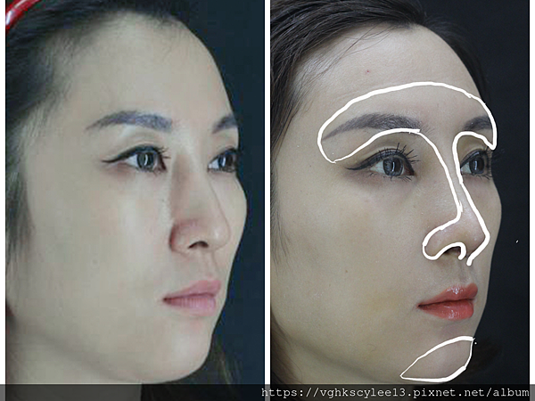 隆鼻價位多少?為什麼差異大!原因? 隆鼻價位多少?為什麼差異大!原因?