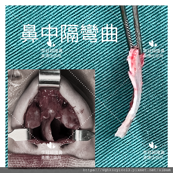 隆鼻價位多少?為什麼差異大!原因? 隆鼻價位多少?為什麼差異大!原因?