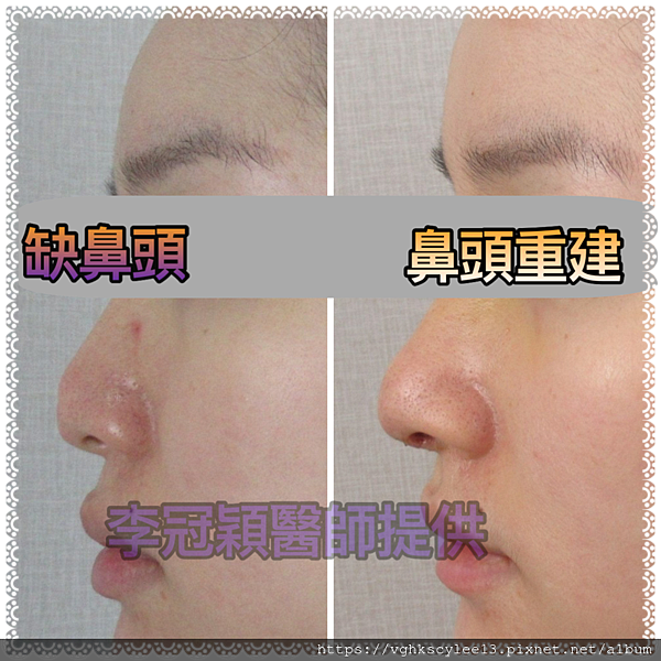 『鼻雕』還是『鼻凋』?到底鼻子埋線有什麼風險必須知道?你的埋 『鼻雕』還是『鼻凋』?到底鼻子埋線有什麼風險必須知道?你的埋