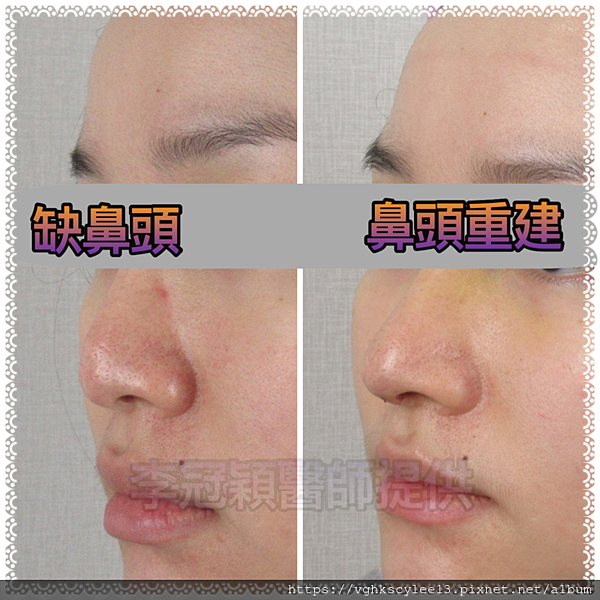 『鼻雕』還是『鼻凋』?到底鼻子埋線有什麼風險必須知道?你的埋 『鼻雕』還是『鼻凋』?到底鼻子埋線有什麼風險必須知道?你的埋