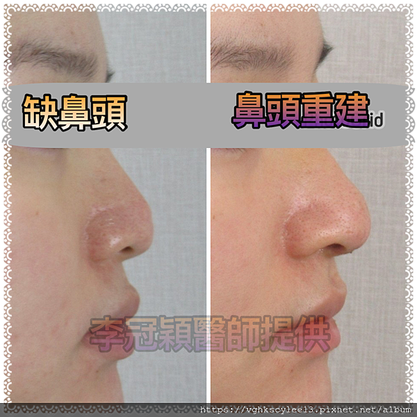 『鼻雕』還是『鼻凋』?到底鼻子埋線有什麼風險必須知道?你的埋 『鼻雕』還是『鼻凋』?到底鼻子埋線有什麼風險必須知道?你的埋