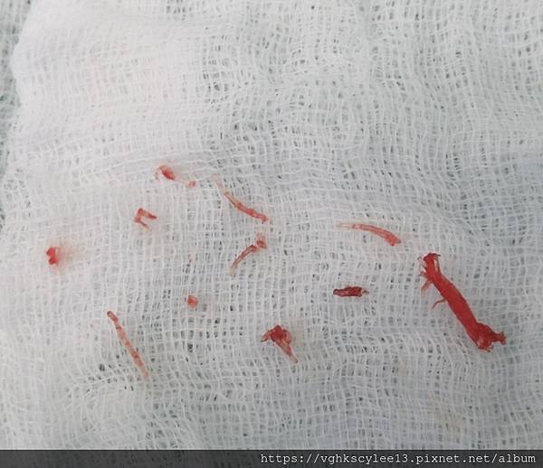 『鼻雕』還是『鼻凋』?到底鼻子埋線有什麼風險必須知道?你的埋 『鼻雕』還是『鼻凋』?到底鼻子埋線有什麼風險必須知道?你的埋