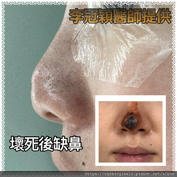 『鼻雕』還是『鼻凋』?到底鼻子埋線有什麼風險必須知道?你的埋 『鼻雕』還是『鼻凋』?到底鼻子埋線有什麼風險必須知道?你的埋