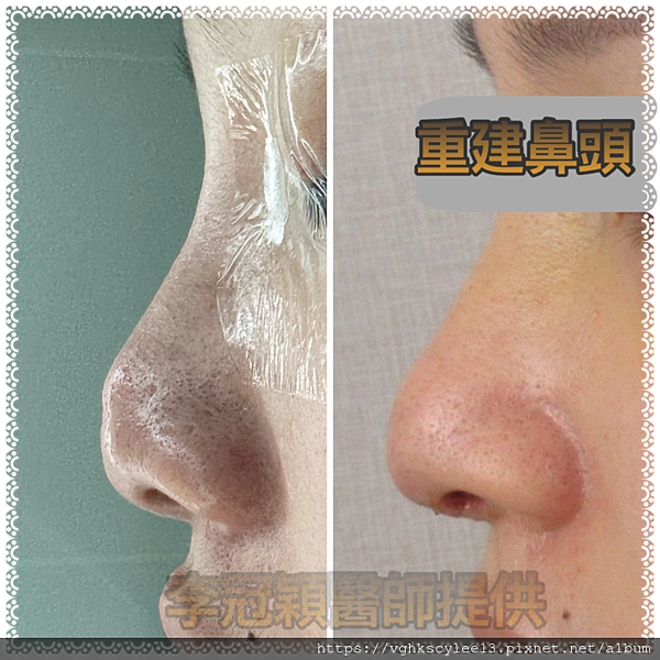 『鼻雕』還是『鼻凋』?到底鼻子埋線有什麼風險必須知道?你的埋 『鼻雕』還是『鼻凋』?到底鼻子埋線有什麼風險必須知道?你的埋