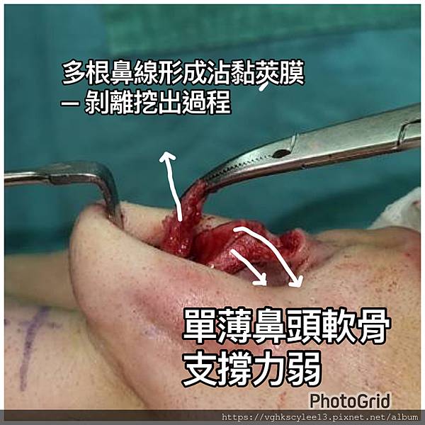 隆鼻價位多少?為什麼差異大!原因? 隆鼻價位多少?為什麼差異大!原因?