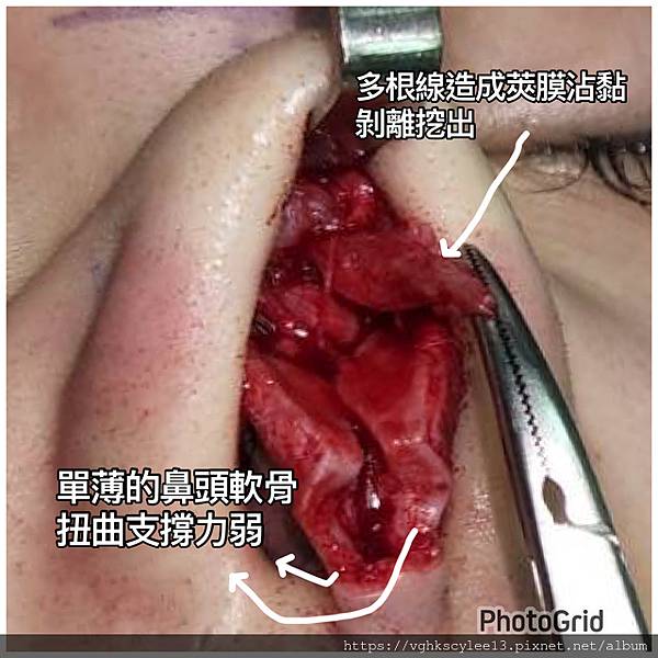 隆鼻價位多少?為什麼差異大!原因? 隆鼻價位多少?為什麼差異大!原因?