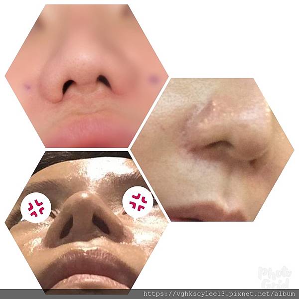 隆鼻價位多少?為什麼差異大!原因? 隆鼻價位多少?為什麼差異大!原因?